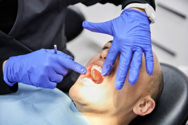 Best Emergency Dentist for Lost Fillings or Crowns in St Petersburg, FL